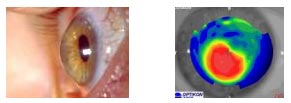 Keratoconus - Contact us in Marietta, GA for eye care.