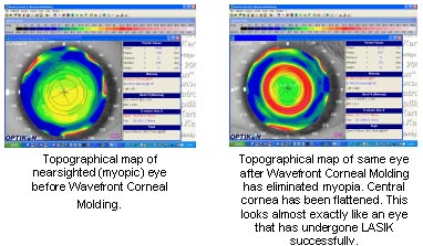 Myopia - Contact us in Marietta and Kennesaw, GA for eye care.