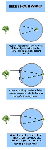 Myopia - Contact us in Marietta and Kennesaw, GA for eye care.